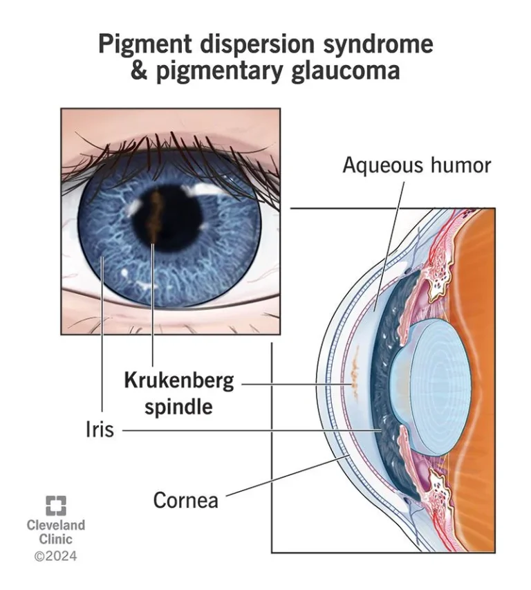 When Eye Pigment Turns Against You: The Hidden Glaucoma