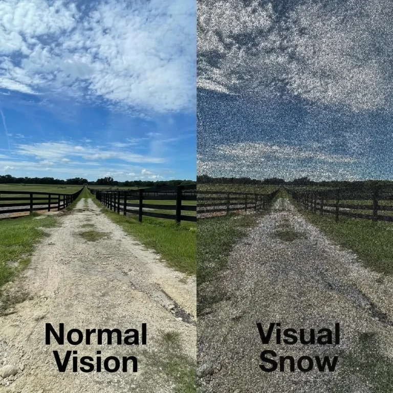 What Is Visual Snow Syndrome and How Does It Work?