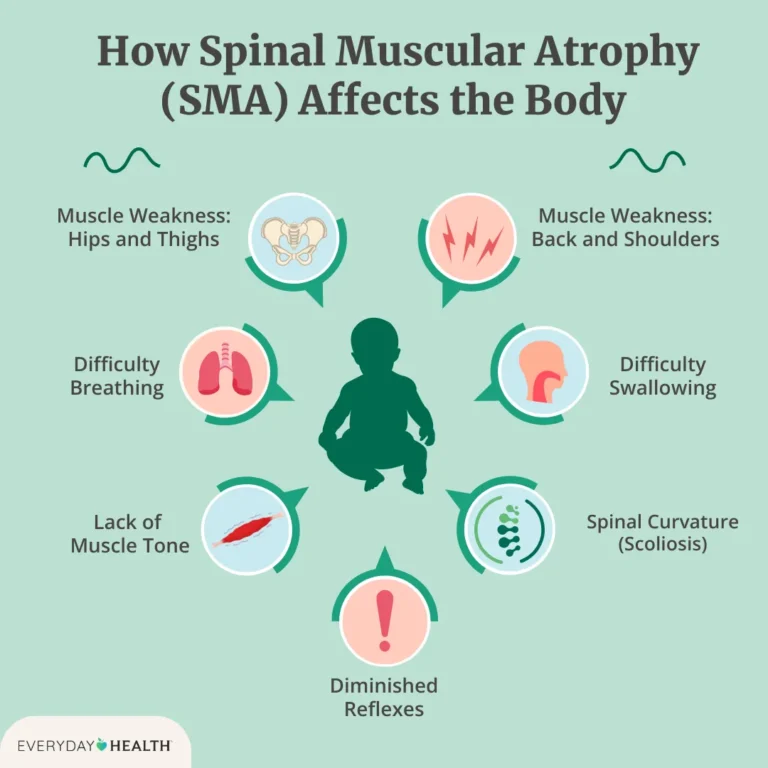 What Is SMA Type 1 and How Is It Treated?
